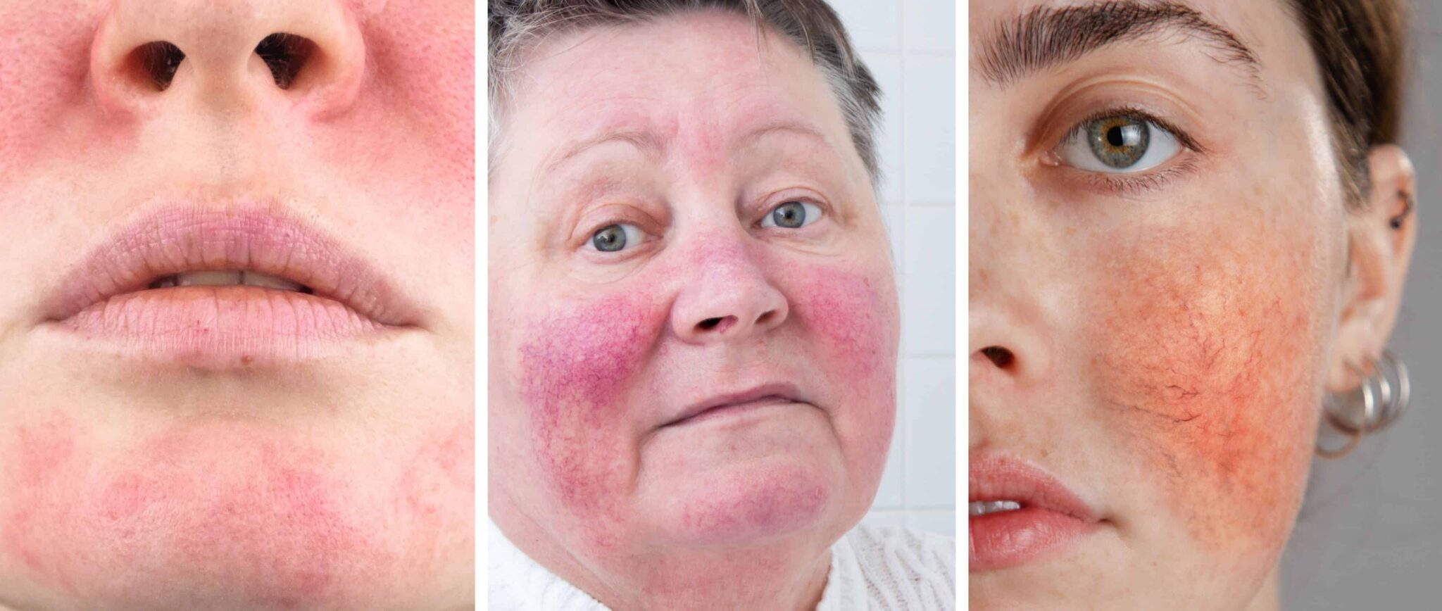 Natürliche Behandlung von Rötungen, Rosacea & Couperose