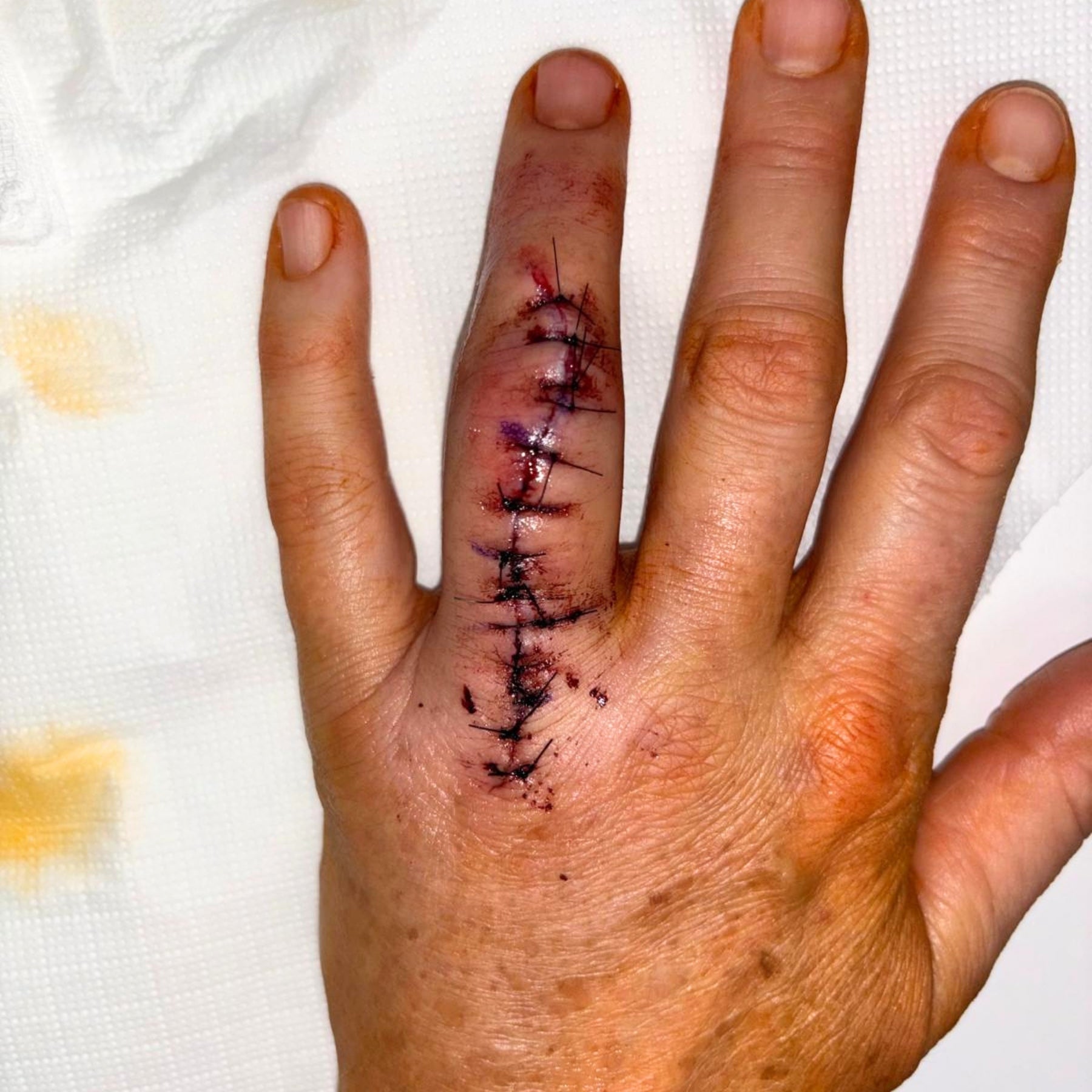 Frisch genähte Schnittwunde am Mittelfinger einer Hand – Anwendungsbeispiel für die heilende Pflege mit dem dieNikolai Wunder-Pflegebalsam aus der Wachau