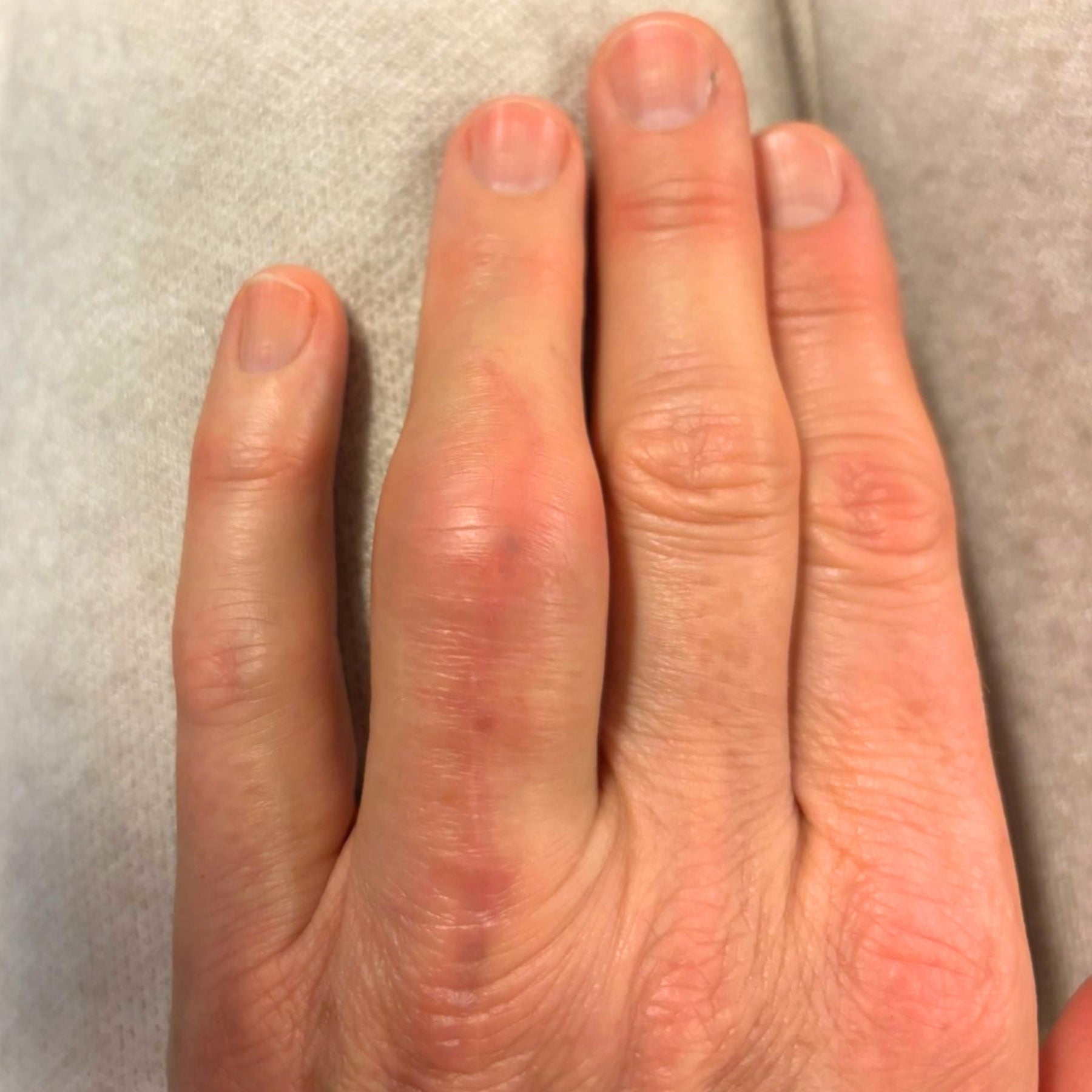 Nahaufnahme einer Hand mit geschwollenem, gerötetem Fingergelenk – Anwendungsfeld für pflegende Demeter Bio-Naturkosmetik von dieNikolai