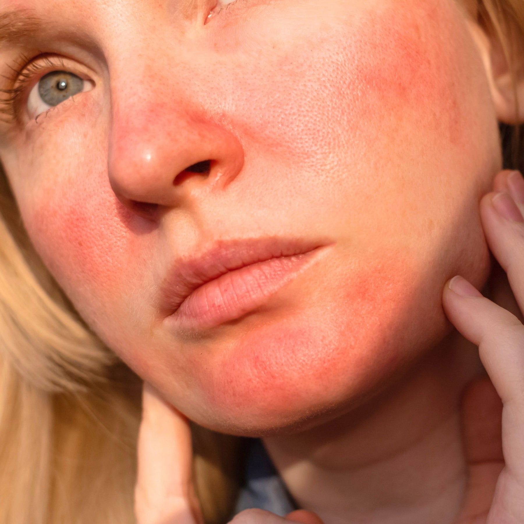 Nahaufnahme einer blonden Frau mit stark geröteter, zu Rosacea neigender Gesichtshaut – Hautberuhigung als Anliegen der dieNikolai Bio-Traubenkosmetik aus der Wachau