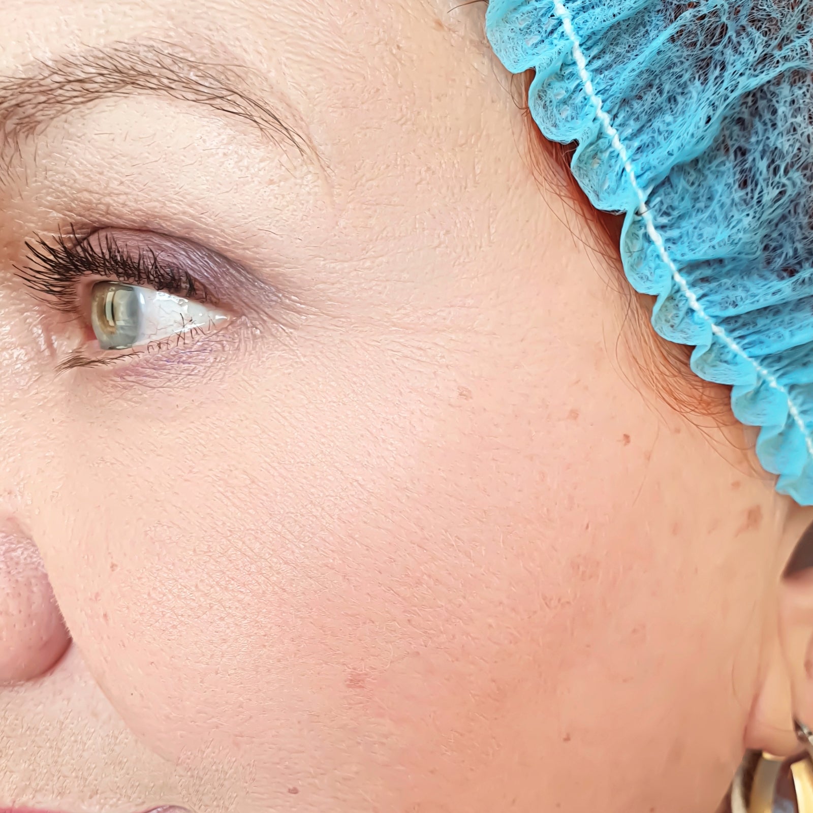 Nahaufnahme eines Frauenauges unter blauer OP-Haube mit großem Gel-Tropfen – schonende Alternative zu invasiven Behandlungen mit dieNikolai Bio-Traubenkosmetik aus der Wachau
