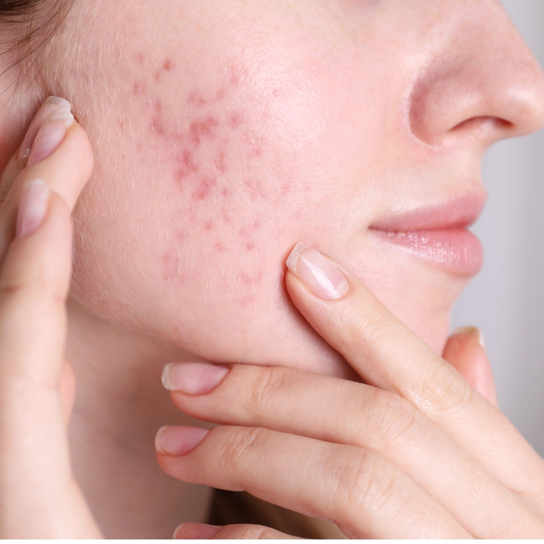 Nahaufnahme einer jungen Frau, die ihre von Akne-Narben geprägte Wange berührt – Hautberuhigung als Anliegen der dieNikolai Demeter Bio-Traubenkosmetik aus der Wachau
